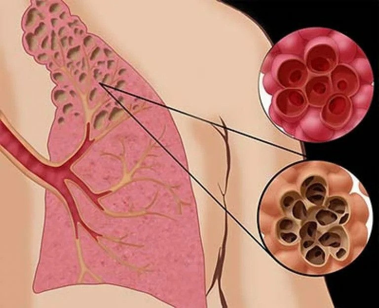 буллёзная-форма-эмфиземы-лёгких