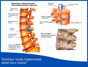 Насколько грыжа позвоночника может быть опасна?
