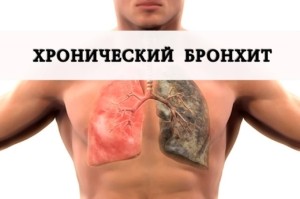 Хронический бронхит