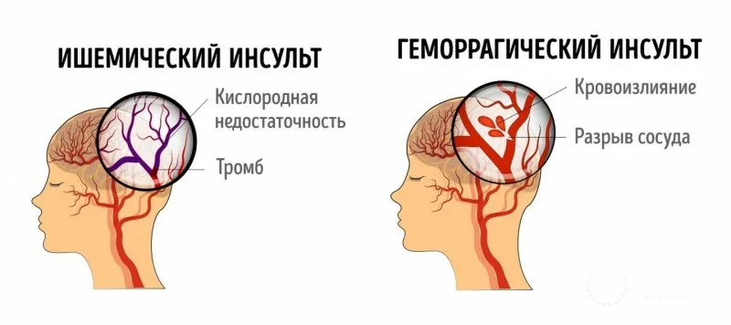 Невероятное исцеление и полное восстановление от инсульта