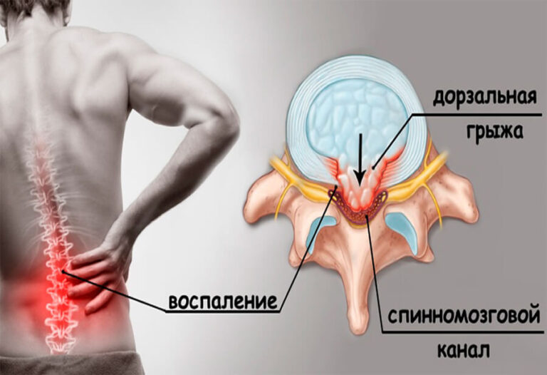 Исцеление грыжи позвоночника после 50