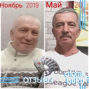 Карцинома носоглотки 3-стадия