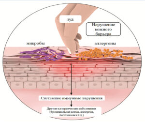 Нейродермит
