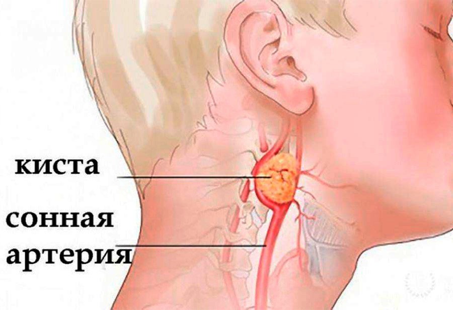 Помогает ли хемохим при онкологии