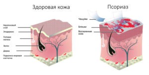Избавление от псориаза, экземы и нейродермита
