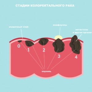 Хемохим отправил Рак 3-ей степени в нокаут